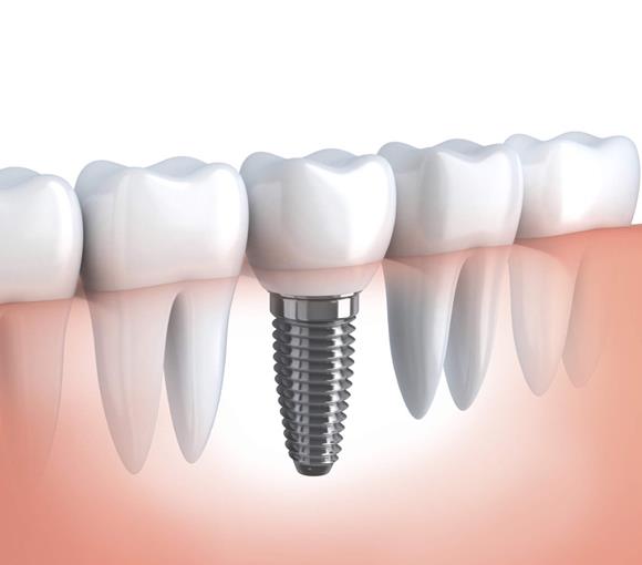 Implantes