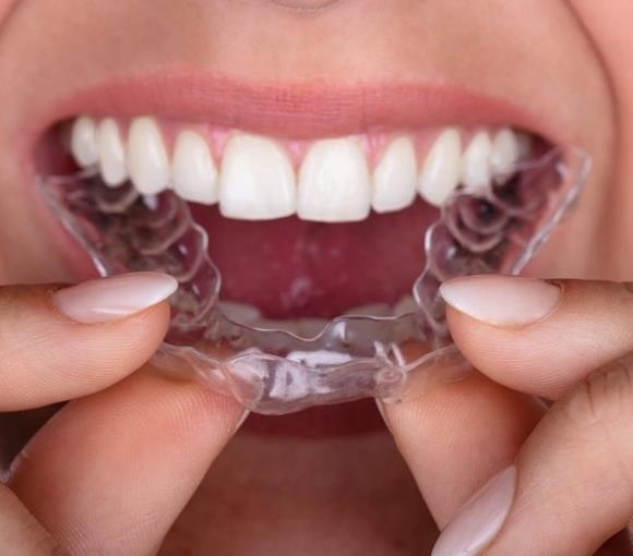 Aparelhos Dentários
